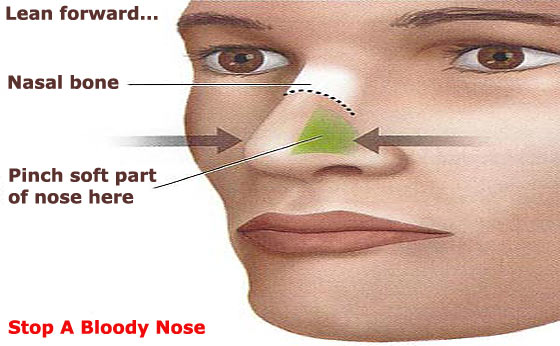 How To Stop A Nose Bleed - how-to-stop-a-nose-bleed
