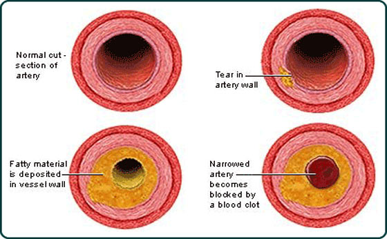 Survive Longer By Lowering Your Cholesterol With These Foods